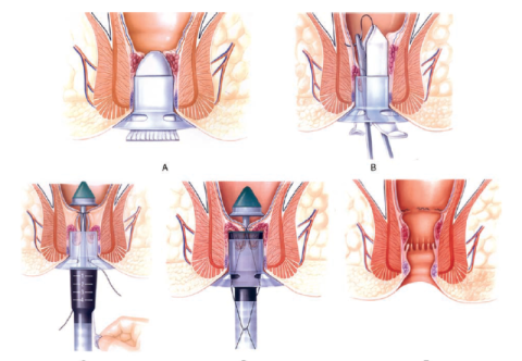 Phẫu thuật Longo - Ưu và nhược điểm